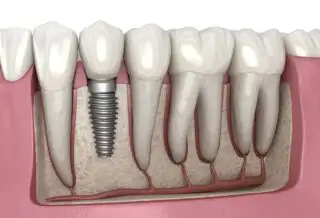 dental implants houston