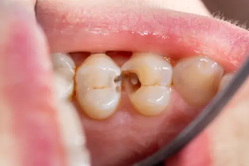 teeth cavities